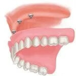 Dentures 5